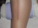 Maximizar la Recuperación: Fisioterapia Postoperatoria